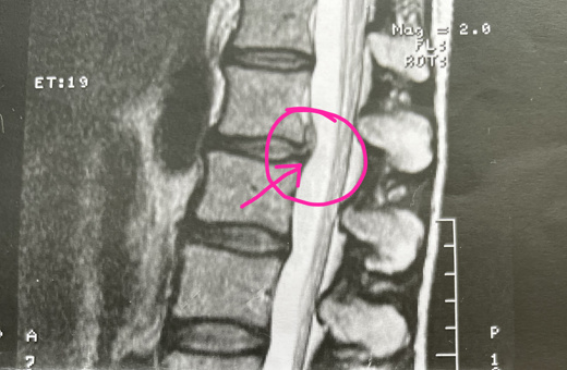 Bandscheibenvorfall mit Sequester, Patient von Margot Zeitvogel-Schönthier Sequestrierter Bandscheibenvorfall, Patient von Margot Zeitvogel-Schönthier